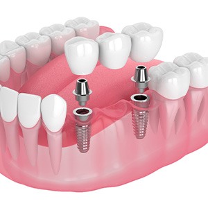 Illustration of an implant bridge
