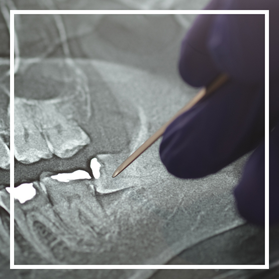 Close up of a dentist gesturing to an x ray of a patient's teeth