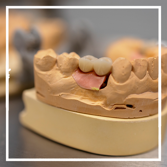 Illustration of a dental implant with a crown replacing a missing tooth